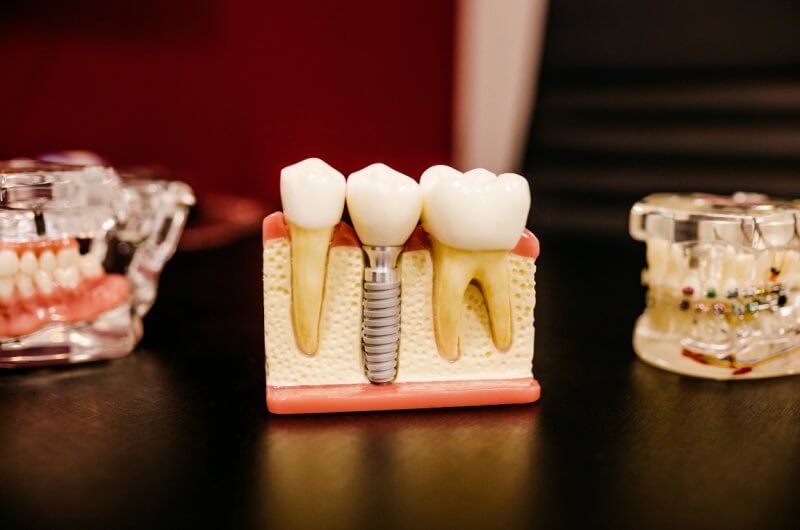 치과-신경치료-비용-보철-종류